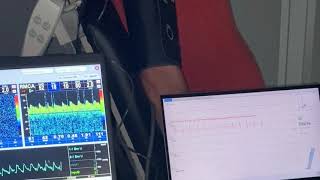 Transcranial doppler recording in POTS [upl. by Carline758]