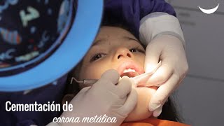 Corona dental en odontopediatría [upl. by Enyala]