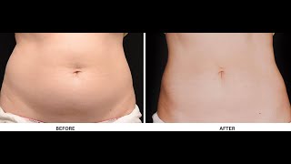 CoolSculpting Transformations at DermaPro Med Spa [upl. by Wieche]