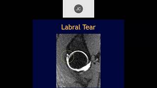 MRI of the Hip Part 7 – Hip Labrum [upl. by Meng141]