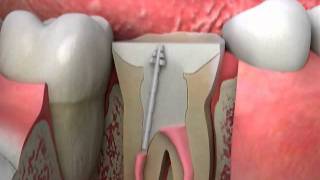 Crowns Post and Core Procedure [upl. by Ecneitap]