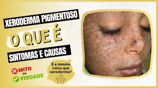 Xeroderma Pigmentoso  O que é sintomas e causas [upl. by Jablon]