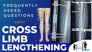 Frequently Asked Questions about Cross Limb Lengthening FAQ  Height Increase Surgery LL Surgery [upl. by Zondra622]