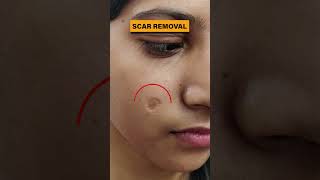 Scar Removal Treatment in Delhi  Scar removal results before and after scar scarremoval scars [upl. by Glass]