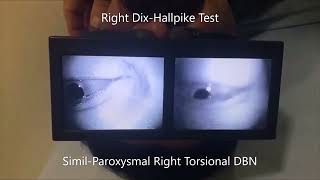 Apogeotropic Left Posterior Semicircular Canal BPPV [upl. by Ahsirak]