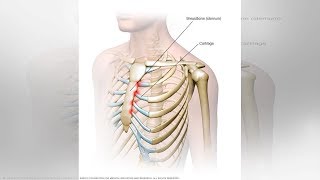 What You Need to Know About Tietze Syndrome  Tita TV [upl. by Nerradal]