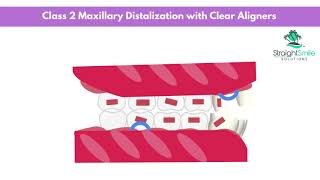 Maxillary Molar Distalization with Invisalign [upl. by Nicky]