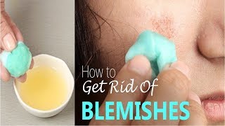 How to Reduce Blemishes  Home Remedies for Blemishes [upl. by Chelsie458]