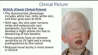 4 Congenital hypomelanosis by Dr Mohamed Aidaros [upl. by Kimmi352]