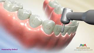 Removing Orthodontic Braces or Debond [upl. by Corotto738]