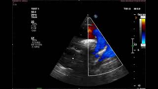 Bicuspid aortic Valve [upl. by Anneh594]