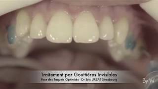 Orthodontie Invisible Strasbourg  Traitement par Gouttières  Dr Eric URSAT [upl. by Erde]