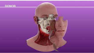 Cameron Underwood Face Transplant Surgical Animation 2018 [upl. by Cash]