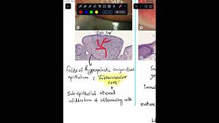 Papillae Vs Follicles in Conjunctiva  Histopathology Shorts [upl. by Boris]