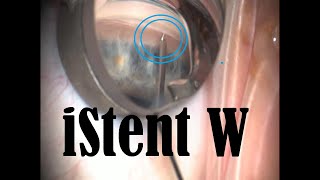 How to iStent Inject W  when the stent slips out [upl. by Essyle242]