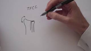 TFCC Lésion du TFCC triangular fibro cartilage complex [upl. by Nawk]