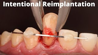 Intentional Reimplantation [upl. by Sharlene]