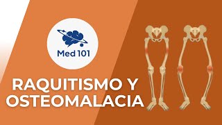 Raquitismo y osteomalacia 101 [upl. by Thesda]