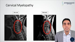 Cervical Myelopathy  What is it How can we treat it [upl. by Adnaloy725]