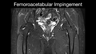 Femoroacetabular Impingement [upl. by Gillman]