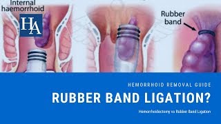 Hemorrhoidectomy vs Rubber Band Ligation Reviews  Recovery Time Cost and Effectiveness [upl. by Mont]