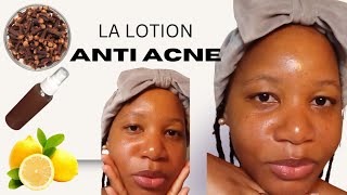 Lotion Tonique Visage Fait Maison  Nettoyant Antiacne Clarifiant [upl. by Rustin]