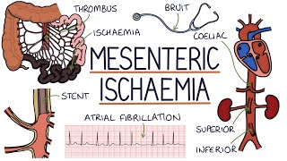 Understanding Mesenteric Ischaemia [upl. by Ariik]