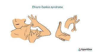 What is Ehlers Danlos Syndrome [upl. by Dowd]