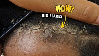 Removing Psoriasis Flaky Scalp Satisfying 373 [upl. by Oivalf]