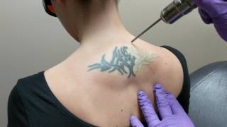 Laser Tattoo Removal  DermMedica [upl. by Sefton]