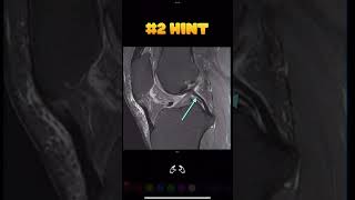 Fig 1A11 Meniscofemoral ligaments Humphrey ligament [upl. by Lisk424]