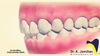 Class 2 elastic in Orthodontics [upl. by Machutte698]