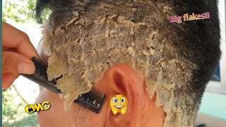 Psoriasis Scalp Removal At Home 350 [upl. by Shelli]