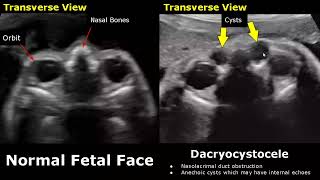 Fetal Face Ultrasound Normal Vs Abnormal Image Appearances  Eye Abnormalities  Obstetric USG [upl. by Eelram620]