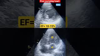 Poor pumping heart l EF 1015 echo shorts [upl. by Emmy]