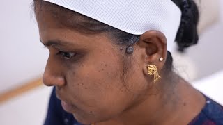 Ear Keloid Removal Procedure [upl. by Waynant1]