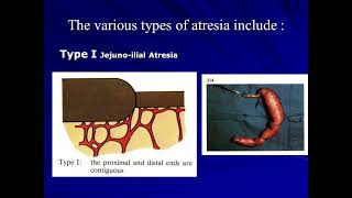 Lec10  Part 5   Surgery Major Group C Dr Raad  Jejunoileal Atresia  Malrotation Volvulus [upl. by Westbrook]