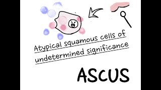 OBGY 04 ASCUS  pap test interpretation and management [upl. by Llerut]