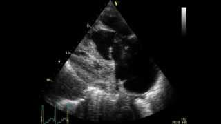 PULMONARY EMBOLISM  EMBOLIE PULMONAIRE  ECHOCARDIOGRAPHY cardiac ultrasound [upl. by Eamanna]