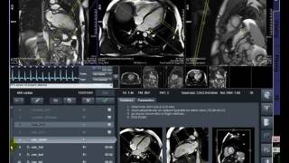 MRI Cardiac CMR [upl. by Anirda]