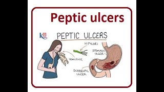 Peptic Ulcers Causes Symptoms  2024 [upl. by Ttennaj]