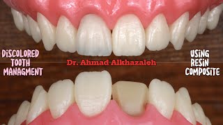 Discolored Tooth Management Using Dental Composite  Polychromatic Layering with Finishing Steps [upl. by Rramahs]