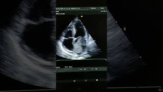 Huge left atrial myxoma  Echocardiography [upl. by Mehitable]