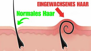 Was sind eingewachsene Haare – und wie werden sie behandelt [upl. by Addam636]