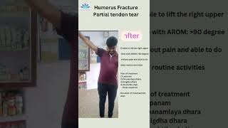 Ligament tear Patient testimonial DrLRakesh MD Panchakarma [upl. by Argyres707]