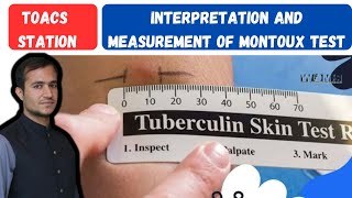 Tuberculin skin test measurement and interpretation positive PPD montoux test patient tuberculosis [upl. by Arundel]