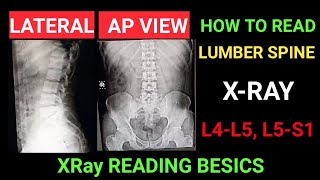 lower back x ray how read L4 L5 S1 lambosacral x ray reading Techcpd [upl. by Ysset]