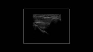 Subacromial impingement on dynamic realtime shoulder ultrasound [upl. by Einattirb]