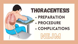 Thoracentesis  Preparationl amp Procedure Steps tutorial NEJM  MS  BOARDS [upl. by Namlak]