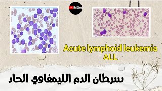 سرطان الدم الليمفاوي الحاد 🔥 Acute lymphoblastic leukemia بالتفصيل ALL [upl. by Anderegg]